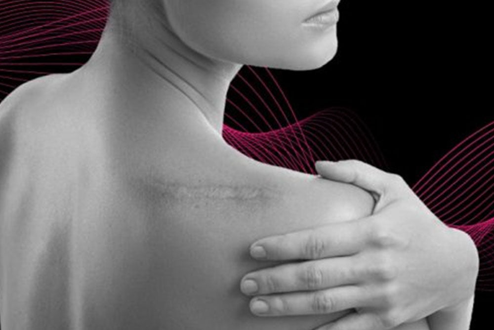CICATRICES: CAUSAS Y TRATAMIENTO