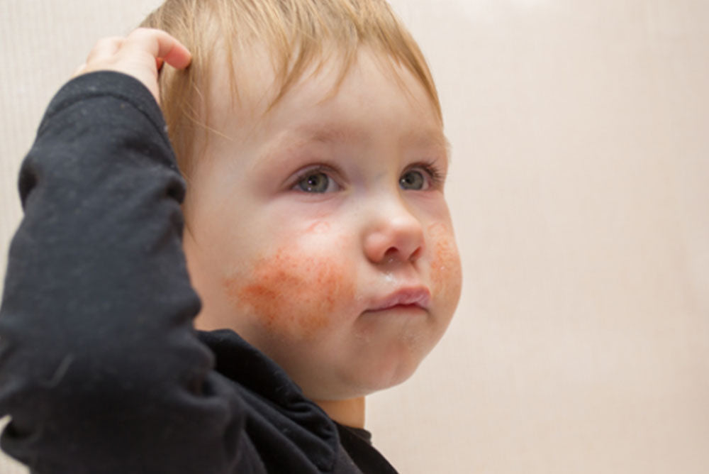 EL DÍA A DÍA DE MI HIJO CON PIEL ATÓPICA